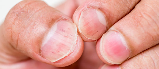 Psoriasis